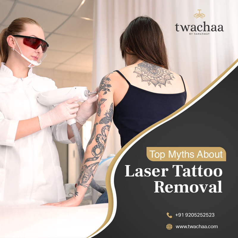 What Are the Top Myths about Laser Tattoo Removal?