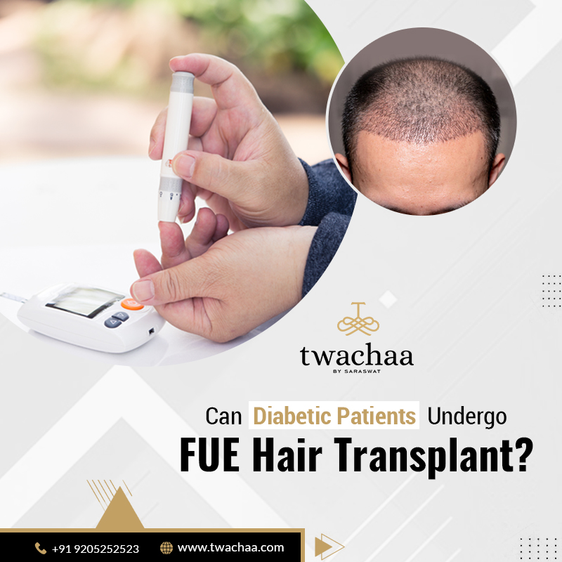 Can Diabetic Patients Undergo FUE Hair Transplant in Faridabad?