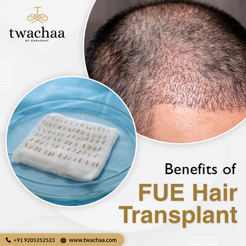 What Are the Benefits of Opting for FUE Hair Transplant in Faridabad?