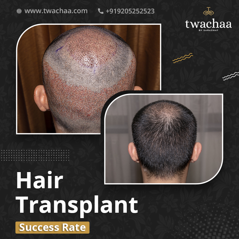 What is the Success Rate of the Best Hair Transplant in Faridabad?