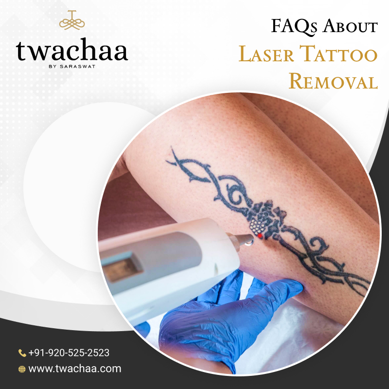 What are the Frequently Asked Questions about Laser Tattoo Removal?