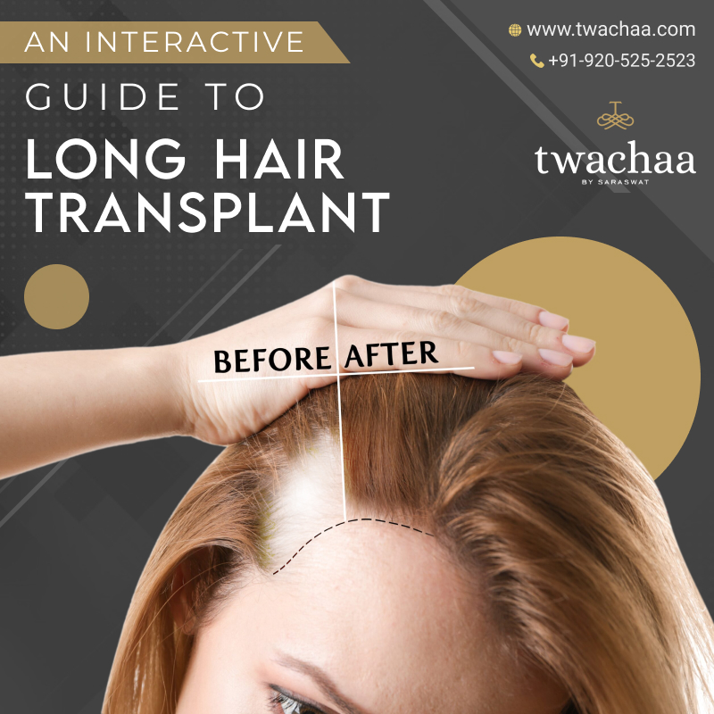 Is Long Hair Transplant a Viable Solution to Hair Loss?