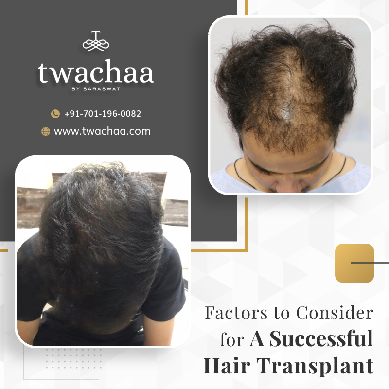 How to Ensure a Successful Hair Transplant Surgery?