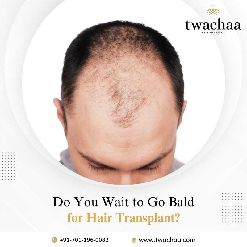 Do You Have to Go Bald for Hair Transplant?- Twachaa By Saraswat