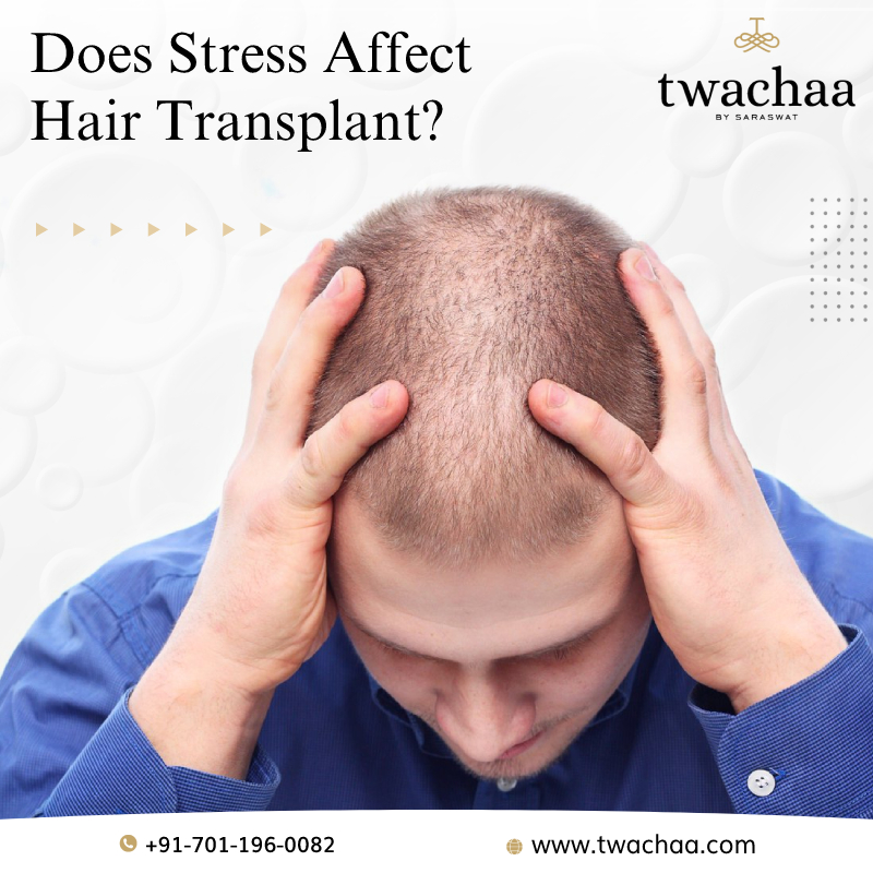 Does Stress Affect Transplanted Hair? – The Best Hair Transplant in Gurgaon