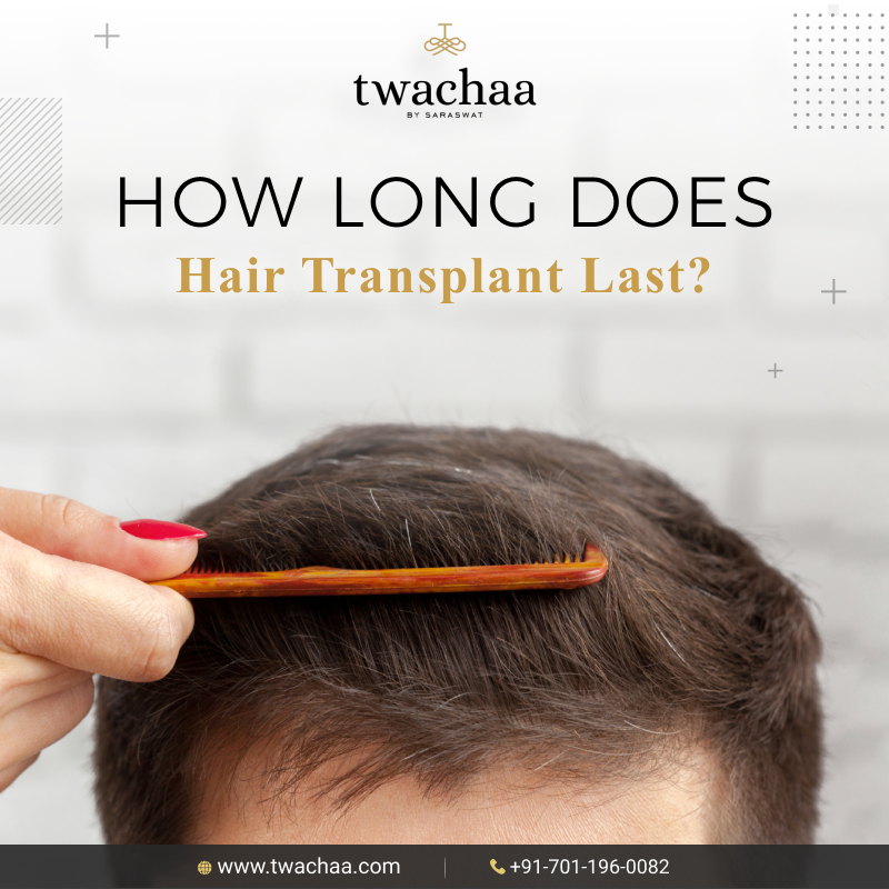 How Long Does Hair Transplant Last?