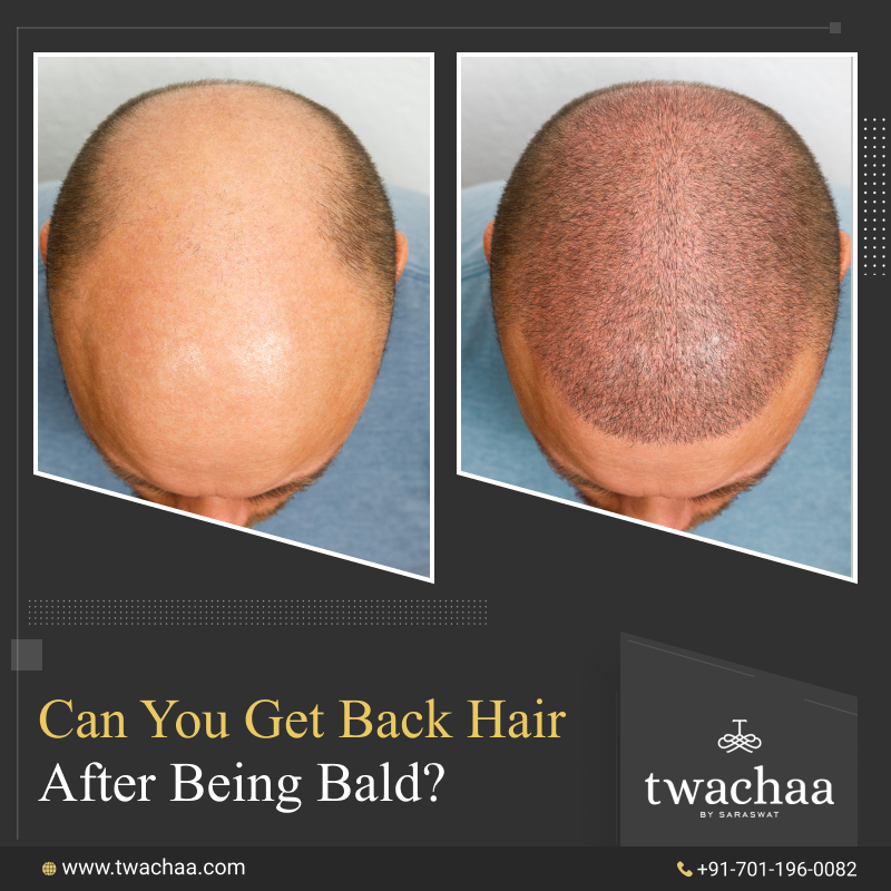 Can a Bald Man Get Hair Back? – Hair Transplant in Gurgaon