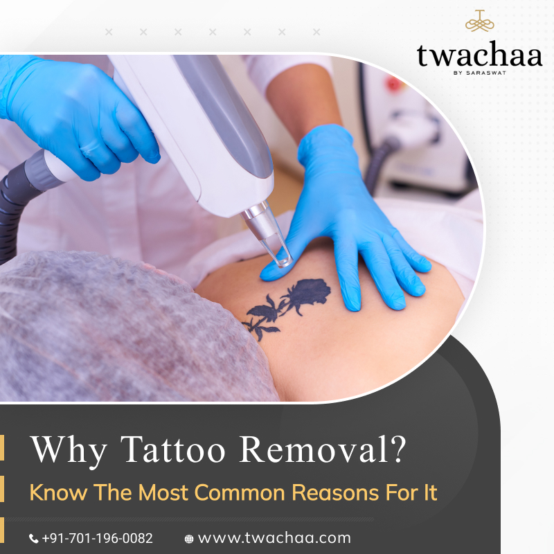 The Most Common Reasons to Go for Tattoo Removal