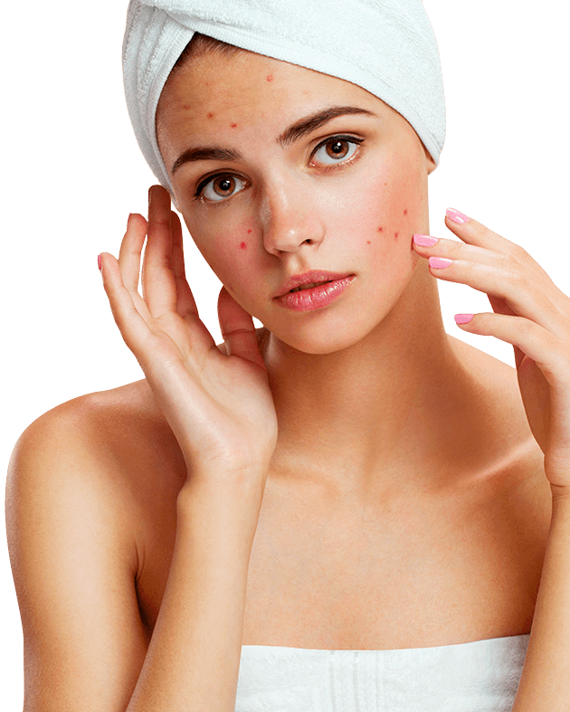 acne marks treatment